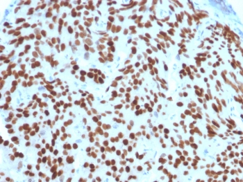IHC staining of FFPE human prostate carcinoma with NKX3.1 antibody (clone NKX3.1/2576). HIER: boil tissue sections in pH6, 10mM citrate buffer, for 10-20 min and allow to cool before testing.~