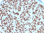 IHC staining of FFPE human prostate carcinoma with NKX3.1 antibody (clone NKX3.1/2576). HIER: boil tissue sections in pH6, 10mM citrate buffer, for 10-20 min and allow to cool before testing.