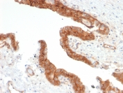 IHC staining of FFPE human prostate carcinoma with CD73 antibody (clone NT5E/2503). HIER: boil tissue sections in pH9 10mM Tris with 1mM EDTA for 10-20 min and allow to cool before testing.