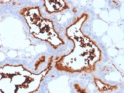 IHC staining of FFPE human lung carcinoma with CD73 antibody (clone NT5E/2503). HIER: boil tissue sections in pH9 10mM Tris with 1mM EDTA for 10-20 min and allow to cool before testing.