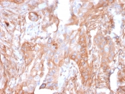 IHC staining of FFPE human colon carcinoma with CD73 antibody (clone NT5E/2503). HIER: boil tissue sections in pH9 10mM Tris with 1mM EDTA for 10-20 min and allow to cool before testing.