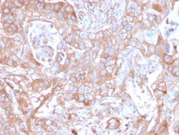 IHC staining of FFPE human colon carcinoma with CD73 antibody (clone NT5E/2505). HIER: boil tissue sections in pH9 10mM Tris with 1mM EDTA for 10-20 min and allow to cool before testing.