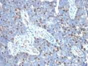 IHC staining of FFPE human colon carcinoma with RORC antibody (clone RORC/2941). HIER: boil tissue sections in pH6, 10mM citrate buffer, for 10-20 min and allow to cool before testing.