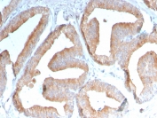 IHC staining of FFPE human prostate carcinoma with ICOSLG antibody (clone ICOSL/3111). HIER: boil tissue sections in pH 9 10mM Tris with 1mM EDTA for 10-20 min and allow to cool before testing.