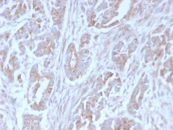 IHC staining of FFPE human colon carcinoma