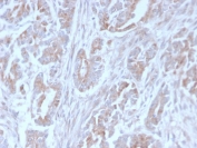 IHC staining of FFPE human colon carcinoma with ICOSLG antibody (clone ICOSL/3111). HIER: boil tissue sections in pH 9 10mM Tris with 1mM EDTA for 10-20 min and allow to cool before testing.