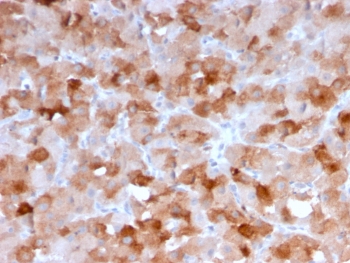 IHC staining of FFPE human squamous cell carcinoma with VISTA antibody (clone VISTA/3007). HIER: boil tissue sections in pH 9, 10mM Tris with 1mM EDTA, 10-20 min and allow to cool before testing.~