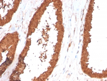 IHC staining of FFPE human prostate carcinoma with TIGIT antibody (clone TIGIT/3017). HIER: boil tissue sections in pH6, 10mM citrate buffer, for 10-20 min and allow to cool before testing.~