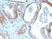 IHC staining of FFPE human prostate carcinoma with TIGIT antibody (clone TIGIT/3016). HIER: boil tissue sections in pH6, 10mM citrate buffer, for 10-20 min and allow to cool before testing.