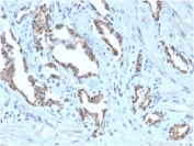 IHC staining of FFPE human prostate carcinoma with biotinylated TIGIT antibody (clone TIGIT/3016). HIER: boil tissue sections in pH 9 10mM Tris with 1mM EDTA for 20 min and allow to cool before testing.