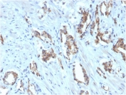 IHC staining of FFPE human prostate carcinoma with biotinylated TIGIT antibody (clone TIGIT/3016). HIER: boil tissue sections in pH 9 10mM Tris with 1mM EDTA for 20 min and allow to cool before testing.