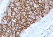 IHC staining of FFPE human breast cancer with HER2 antibody (clone 2KRI7-3). HIER: boil tissue sections in pH6, 10mM citrate buffer, for 10-20 min and allow to cool before testing.