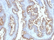 IHC staining of FFPE human prostate carcinoma with CD73 antibody (clone NT5E/2545). HIER: boil tissue sections in pH9 10mM Tris with 1mM EDTA for 10-20 min and allow to cool before testing.