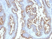 IHC staining of FFPE human prostate carcinoma with CD73 antibody (clone NT5E/2545). HIER: boil tissue sections in pH9 10mM Tris with 1mM EDTA for 10-20 min and allow to cool before testing.