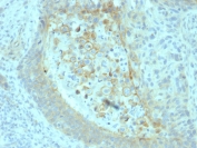 IHC staining of FFPE human pancreatic carcinoma with CD73 antibody (clone NT5E/2545). HIER: boil tissue sections in pH9 10mM Tris with 1mM EDTA for 10-20 min and allow to cool before testing.