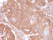 IHC staining of FFPE human colon carcinoma with CD73 antibody (clone NT5E/2545). HIER: boil tissue sections in pH9 10mM Tris with 1mM EDTA for 10-20 min and allow to cool before testing.