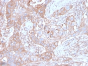 IHC staining of FFPE human colon carcinoma with CD73 antibody (clone NT5E/2646). HIER: boil tissue sections in pH9 10mM Tris with 1mM EDTA for 10-20 min and allow to cool before testing.