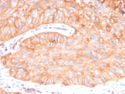 IHC staining of FFPE human colon carcinoma with CD73 antibody (clone NT5E/2646). HIER: boil tissue sections in pH9 10mM Tris with 1mM EDTA for 10-20 min and allow to cool before testing.