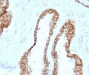 IHC staining of FFPE human prostate carcinoma with CK5 antibody (clone CTKN5-1). HIER: boil tissue sections in pH6, 10mM citrate buffer, for 10-20 min and allow to cool before testing.