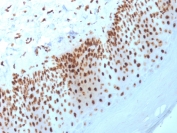 IHC staining of FFPE human basal cell carcinoma with Nucleophosmin antibody (clone NPM1/3398). HIER: boil tissue sections in pH6, 10mM citrate buffer, for 10-20 min and allow to cool before testing.