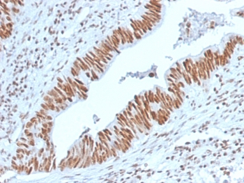 IHC staining of FFPE human colon carcinoma with Nucleophosmin antibody (clone NPM1/3398). HIER: boil tissue sections in pH6, 10mM citrate buffer, for 10-20 min and allow to cool before testing.~