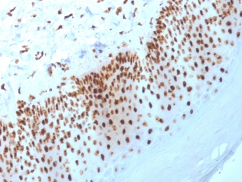 IHC staining of FFPE human basal cell carc