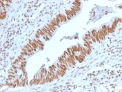 IHC staining of FFPE human colon carcinoma with Nucleophosmin antibody (clone NPM1/3398). HIER: boil tissue sections in pH6, 10mM citrate buffer, for 10-20 min and allow to cool before testing.