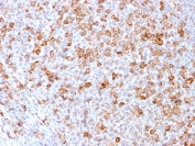IHC staining of FFPE human tonsil with CD3e antibody (clone C3e/3171R). HIER: boil tissue sections in pH 9 10mM Tris with 1mM EDTA for 10-20 min and allow to cool before testing.
