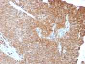IHC testing of FFPE human urothelial carcinoma with SERBP1 antibody (clone SERBP1/3493). Required HIER: boil tissue sections in pH6, 10mM citrate buffer, for 10-20 min followed by cooling at RT for 20 min.
