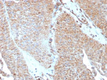IHC testing of FFPE human urothelial carcinoma with SERBP1 antibody (clone SERBP1/3493). Required HIER: boil tissue sections in pH6, 10mM citrate buffer, for 10-20 min followed by cooling at RT for 20 min.~