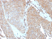 IHC testing of FFPE human urothelial carcinoma with SERBP1 antibody (clone SERBP1/3493). Required HIER: boil tissue sections in pH6, 10mM citrate buffer, for 10-20 min followed by cooling at RT for 20 min.