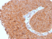 IHC testing of FFPE human urothelial carcinoma with SERBP1 antibody (clone SERBP1/3495). Required HIER: boil tissue sections in pH6, 10mM citrate buffer, for 10-20 min followed by cooling at RT for 20 min.