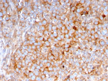 IHC testing of FFPE human urothelial carcinoma with SERBP1 antibody (clone SERBP1/3495). Required HIER: boil tissue sections in pH6, 10mM citrate buffer, for 10-20 min followed by cooling at RT for 20 min.~