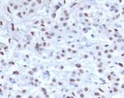 IHC testing of FFPE human mesothelioma with recombinant Wilms Tumor 1 antibody (clone MMWT1-1). Required HIER: boil tissue sections in pH 9 10mM Tris with 1mM EDTA for 10-20 min followed by cooling at RT for 20 min.