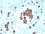 IHC staining of FFPE human lung adenocarcinoma with biotin-conjugated Napsin A antibody (clone NAPSA/3308). HIER: boil tissue sections in pH 9 10mM Tris with 1mM EDTA for 20 min and allow to cool before testing.