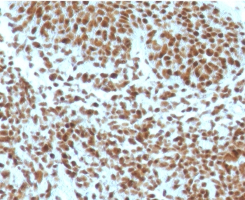 IHC staining of FFPE human basal cell carcinoma with NPM antibody (clone NLPP1-1). HIER: boil tissue sections in pH 9 10mM Tris with 1mM EDTA for 10-20 min and allow to cool before testing.~