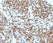 IHC staining of FFPE human basal cell carcinoma with NPM antibody (clone NLPP1-1). HIER: boil tissue sections in pH 9 10mM Tris with 1mM EDTA for 10-20 min and allow to cool before testing.