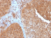 IHC testing of FFPE human urothelial carcinoma with SERBP1 antibody (clone SERBP1/3497). Required HIER: boil tissue sections in pH6, 10mM citrate buffer, for 10-20 min followed by cooling at RT for 20 min.
