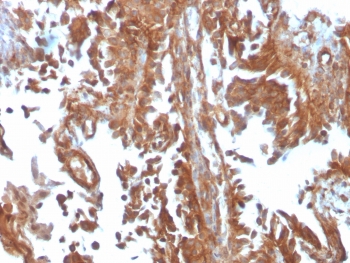 IHC testing of FFPE human urothelial carcinoma with SERBP1 antibody (clone SERBP1/3497). Required HIER: boil tissue sections in pH6, 10mM citrate buffer, for 10-20 min followed by cooling at RT for 20 min.~