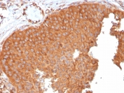 IHC testing of FFPE human urothelial carcinoma with SERBP1 antibody (clone SERBP1/3496). Required HIER: boil tissue sections in pH6, 10mM citrate buffer, for 10-20 min followed by cooling at RT for 20 min.