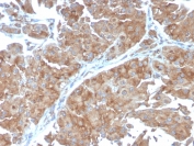 IHC testing of FFPE human urothelial carcinoma with SERBP1 antibody (clone SERBP1/3498). Required HIER: boil tissue sections in pH6, 10mM citrate buffer, for 10-20 min followed by cooling at RT for 20 min.
