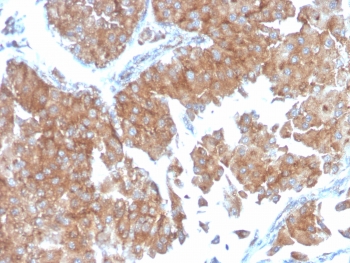 IHC testing of FFPE human urothelial carcinoma with SERBP1 antibody (clone SERBP1/3498). Required HIER: boil tissue sections in pH6, 10mM citrate buffer, for 10-20 min followed by cooling at RT for 20 min.~