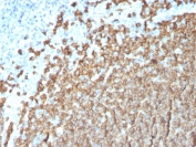 IHC staining of FFPE human tonsil tissue with CD20 antibody (clone MS4A1/3411). HIER: boil tissue sections in pH6, 10mM citrate buffer, for 10-20 min and allow to cool before testing.