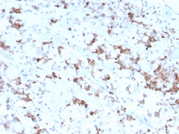 IHC testing of FFPE human pituitary tissue with Prolactin antibody (clone PRL/2641). Required HIER: boil tissue sections in pH6, 10mM citrate buffer, for 10-20 min followed by cooling at RT for 20 min.~