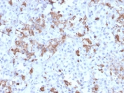 IHC testing of FFPE human pituitary tissue with Prolactin antibody (clone PRL/2642). Required HIER: boil tissue sections in pH6, 10mM citrate buffer, for 10-20 min followed by cooling at RT for 20 min.