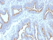 IHC staining of FFPE human ovarian carcinoma with ATG5 antibody (clone ATG5/2492). HIER: boil tissue sections in pH 9 10mM Tris with 1mM EDTA for 10-20 min and allow to cool before testing.