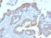 IHC staining of FFPE human endometrial carcinoma with ATG5 antibody (clone ATG5/2492). HIER: boil tissue sections in pH 9 10mM Tris with 1mM EDTA for 10-20 min and allow to cool before testing.