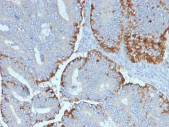IHC staining of FFPE human colon carcinoma with ATG5 antibody. HIER: boil tissue sections in pH 9 10mM Tris with 1mM EDTA for 10-20 min and allow to cool before testing.