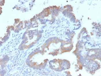 IHC staining of FFPE human endometrial carcinoma with ATG5 antibody. HIER: boil tissue sections in pH 9 10mM Tris with 1mM EDTA for 10-20 min and allow to cool before testing.