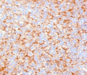 IHC testing of FFPE human urothelial carcinoma with SERBP1 antibody (clone PARB1-1). Required HIER: boil tissue sections in pH 9 10mM Tris with 1mM EDTA for 10-20 min followed by cooling at RT for 20 min.